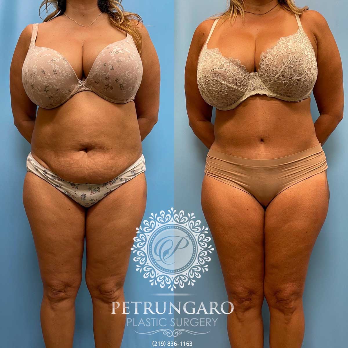 tummy-tuck-lipo-before-after-111