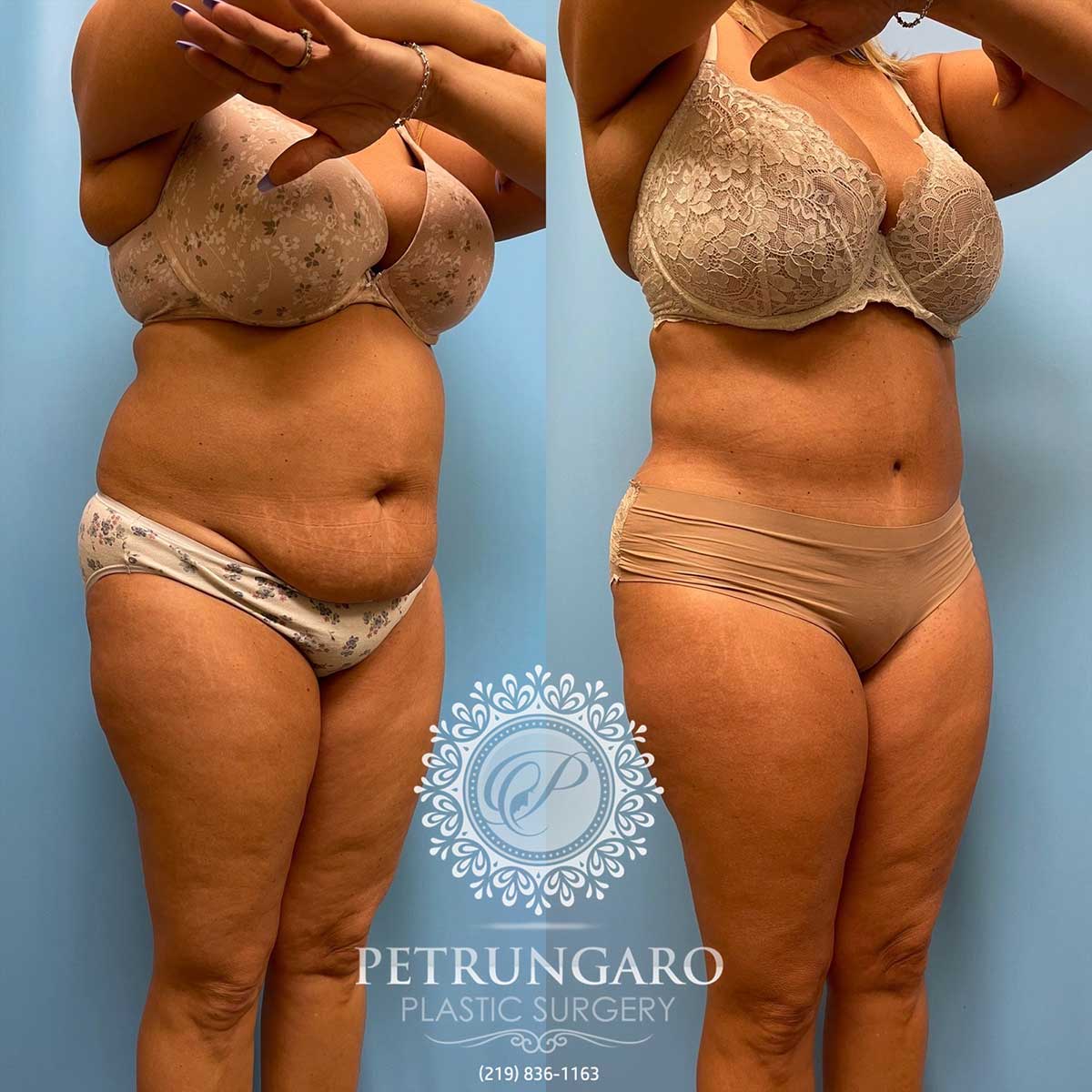 tummy-tuck-lipo-before-after-114
