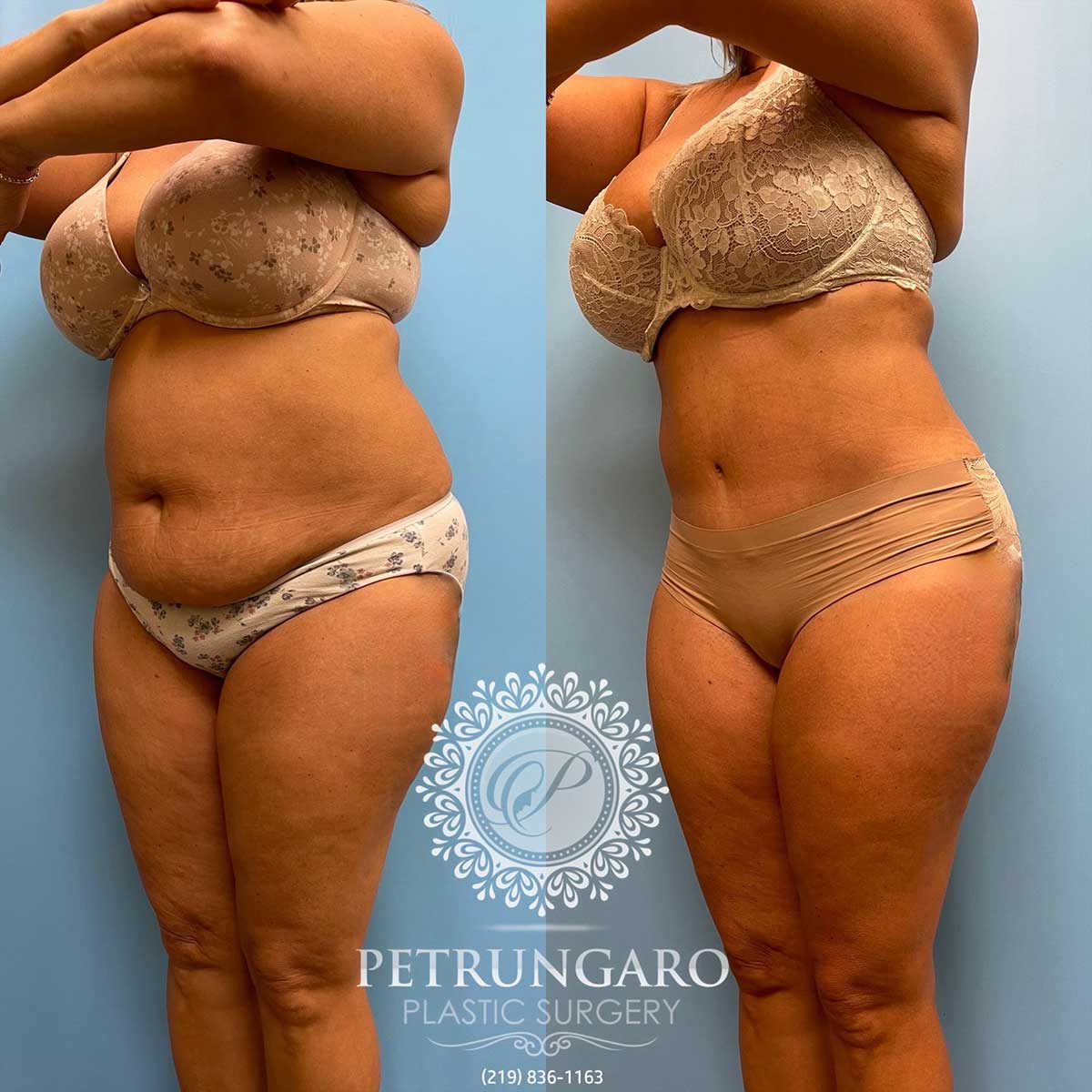 tummy-tuck-lipo-before-after-115