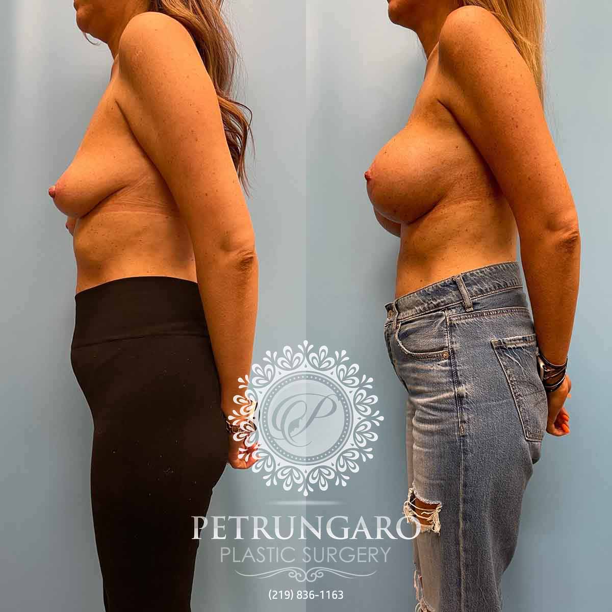 3-months-out-from-periareolar-augmentation-mastopexy-breast-augmentation-implants-2