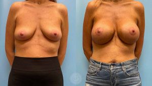3-months-out-from-periareolar-augmentation-mastopexy-breast-augmentation-implants-featured