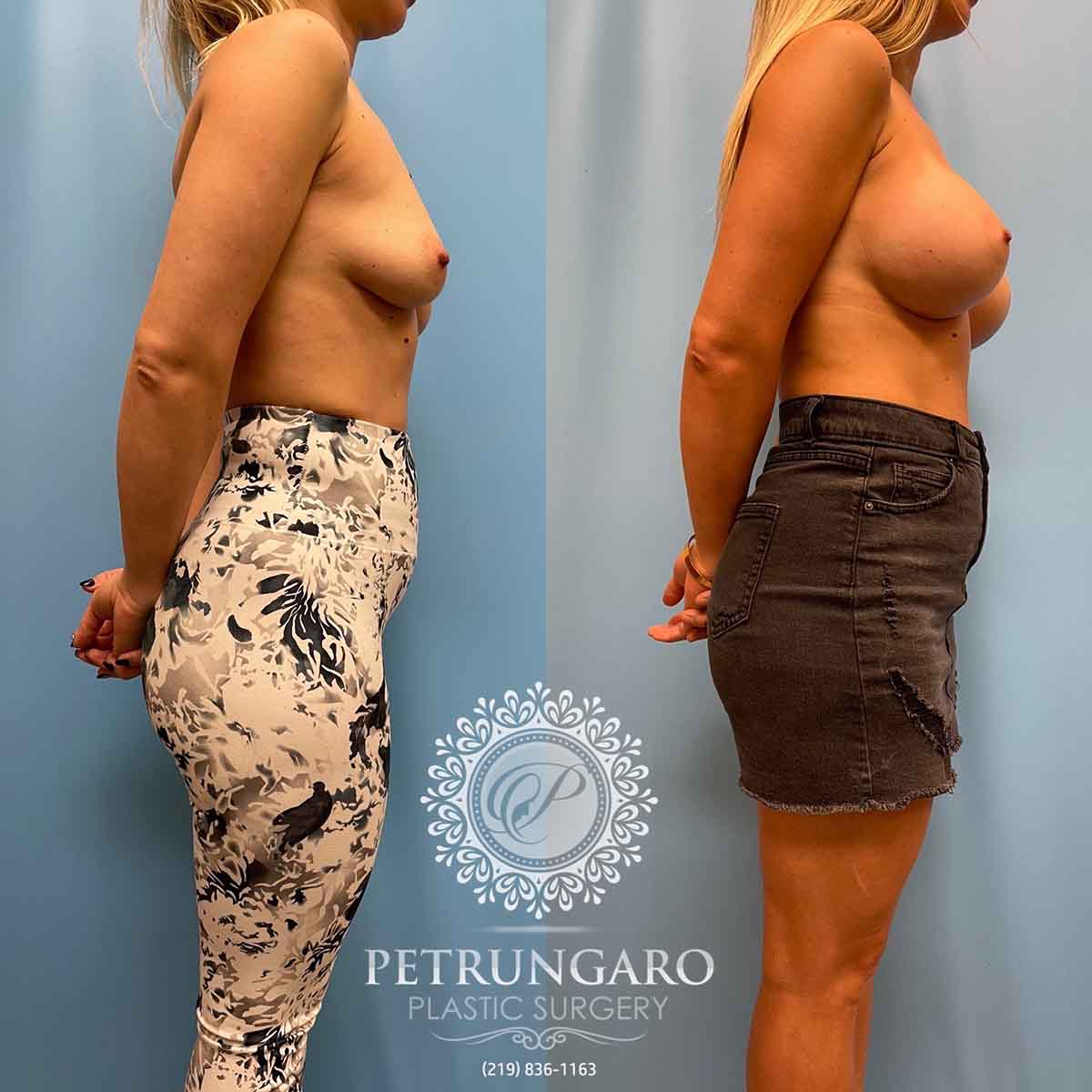 breast-augmentation-natrelle-inspira-before-after-3