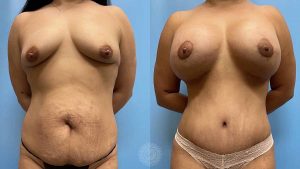 mommy-makeover-tummy-tuck-lipo-360-breast-implants-butt-lift-featured