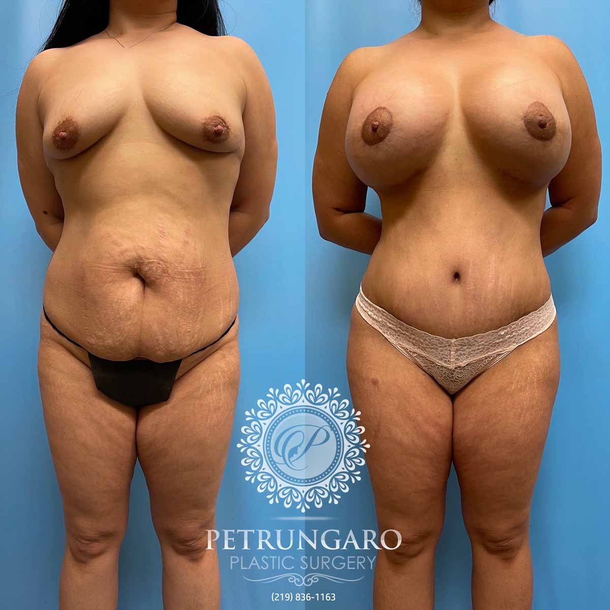 mommy-makeover-tummy-tuck-lipo-breast-implants-butt-lift-6