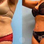 tummy-tuck-with-lipo-360featured