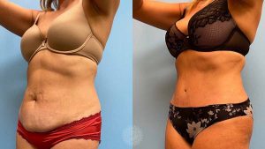 tummy-tuck-with-lipo-360featured