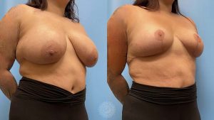 Breast-reduction-patient-feature