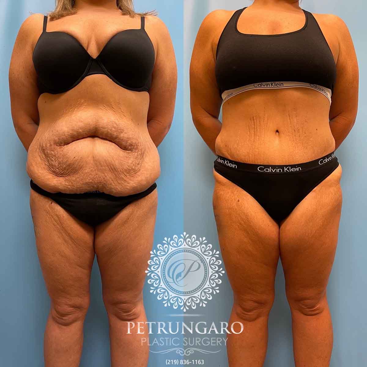 tummy-tuck-liposuction-360-brazilian-butt-lift-1