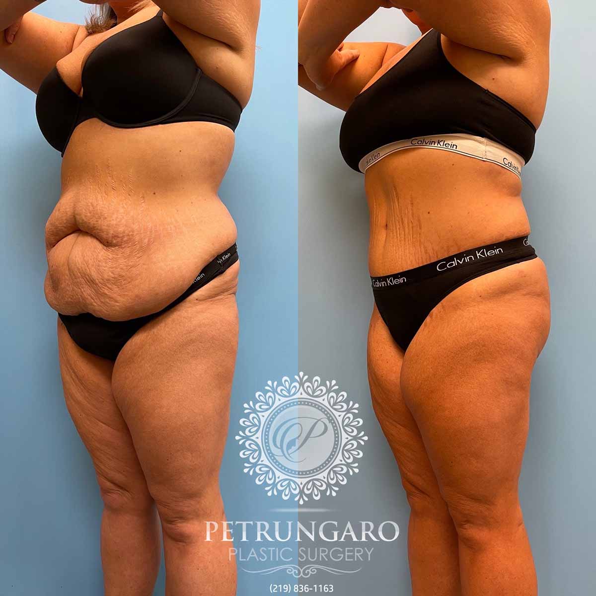 tummy-tuck-liposuction-360-brazilian-butt-lift-5