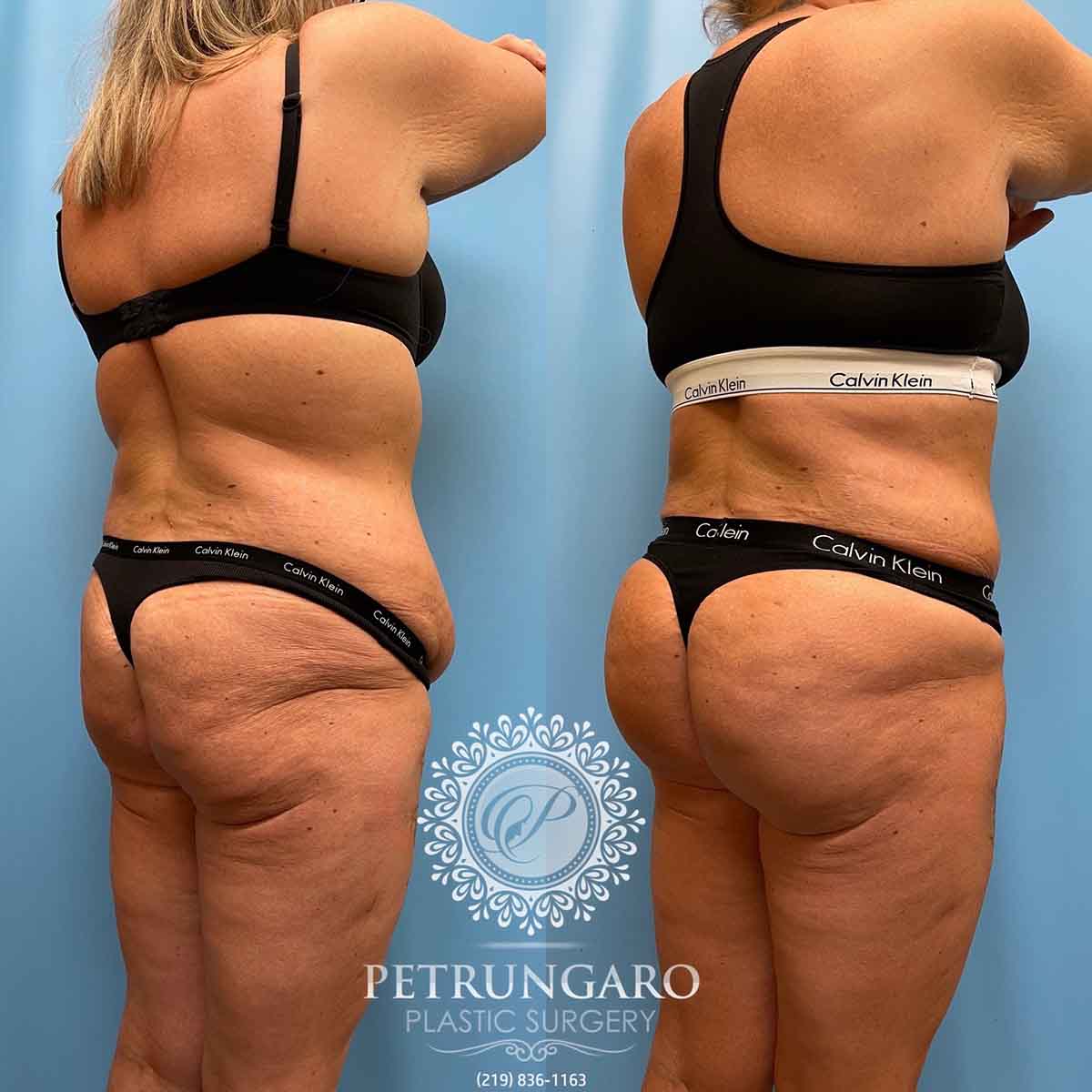 tummy-tuck-liposuction-360-brazilian-butt-lift-6