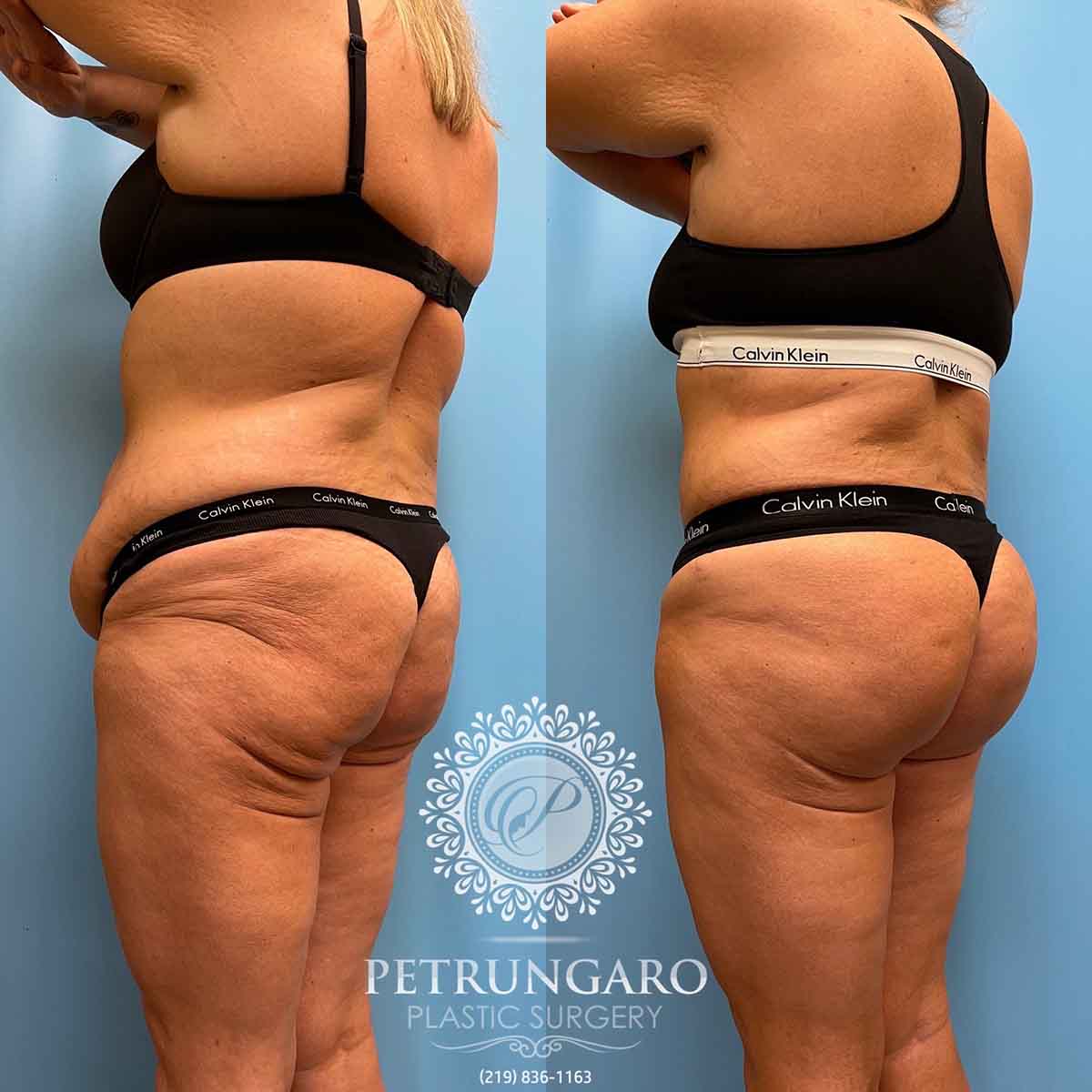 tummy-tuck-liposuction-360-brazilian-butt-lift-7